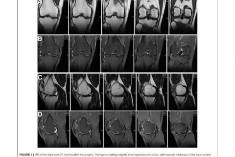 Исследователи КФУ успешно использовали клеточные технологии для лечения дефекта хрящевой ткани коленного сустава у пациента 